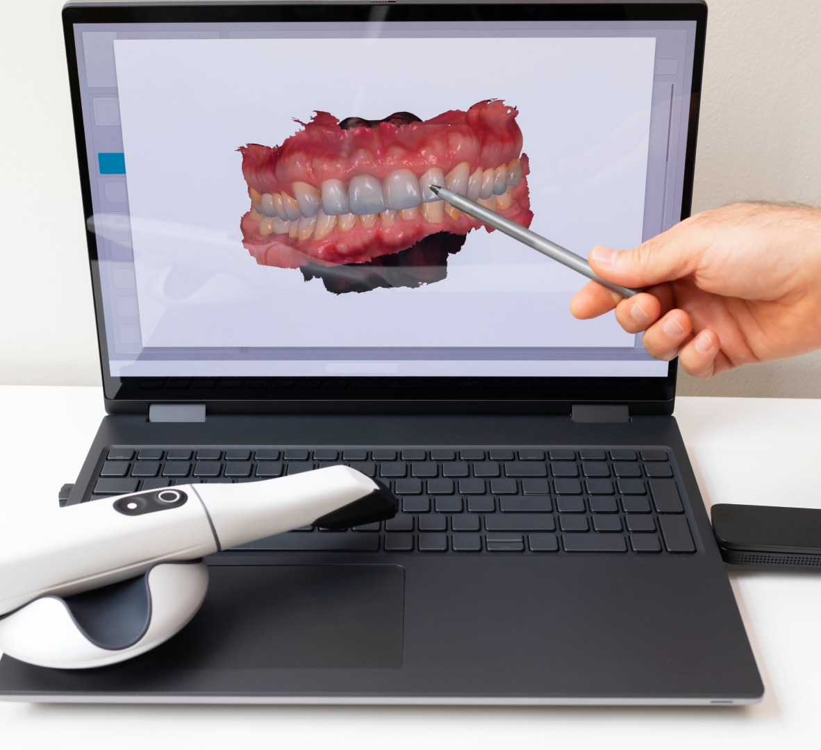 Dental scan displayed on a laptop screen.