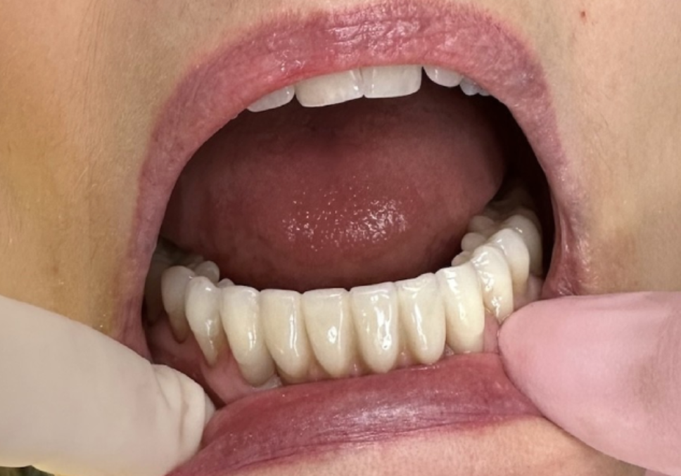 Open mouth showing dental prosthetics.