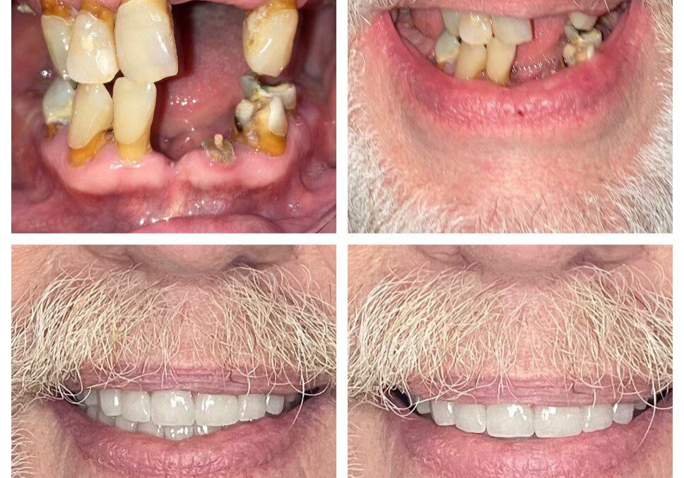 Dental transformation with new, healthy teeth.