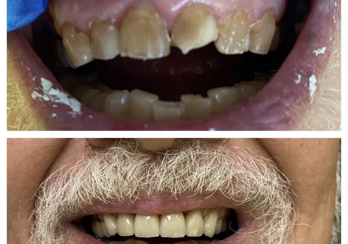 Before and after dental restoration comparison.